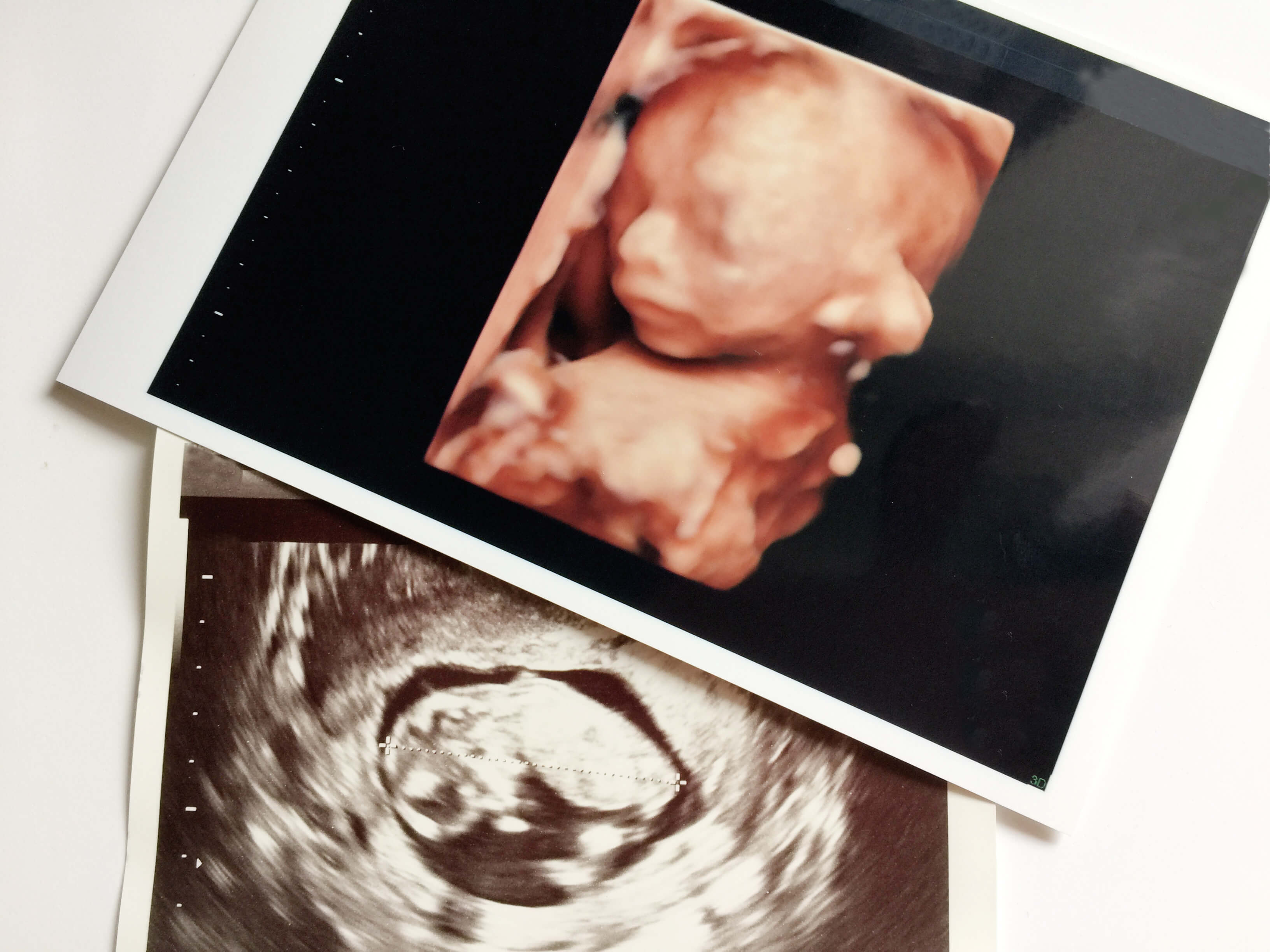 お腹の中の胎児のエコー写真